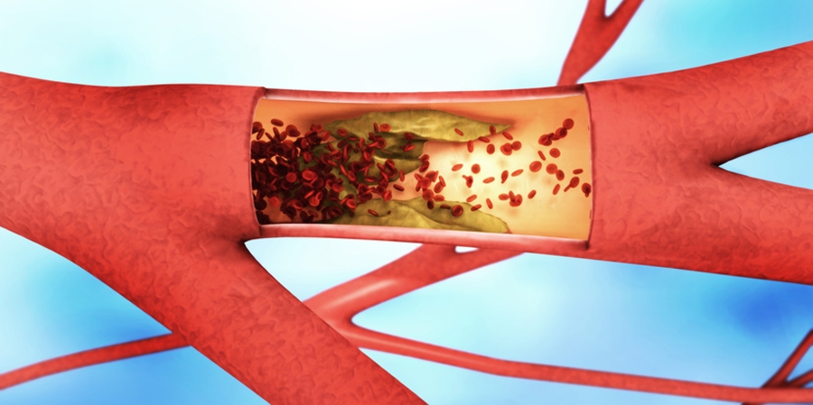 Neue Theorie zu Arteriosklerose stellt bisherige Lehrmeinung in Frage